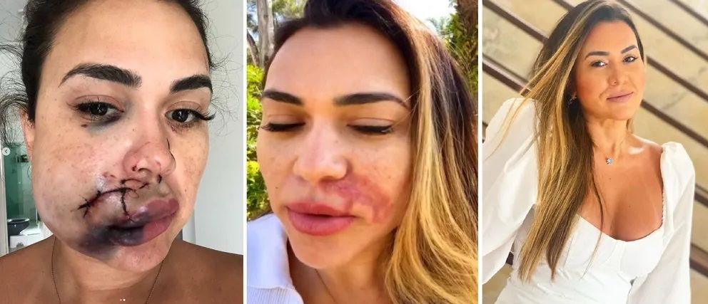 Após quase 5 anos, mulher acusada de agredir Milka Borges será julgada